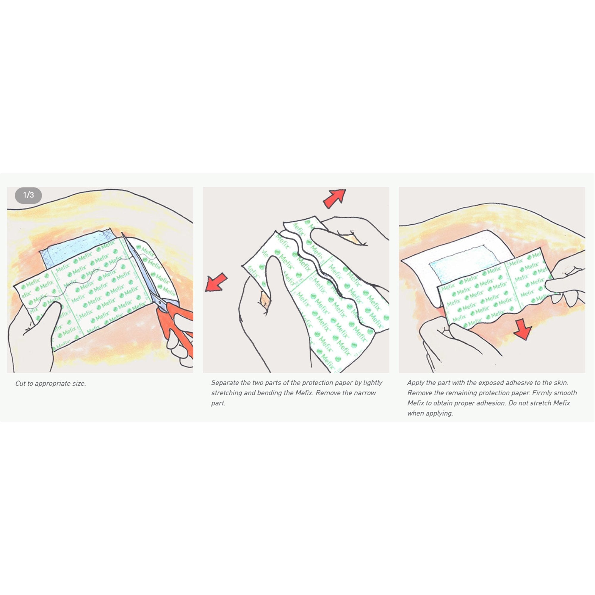 Mefix® Nonwoven Dressing Retention Tape, 2 Inch x 11 Yard (1 Unit)