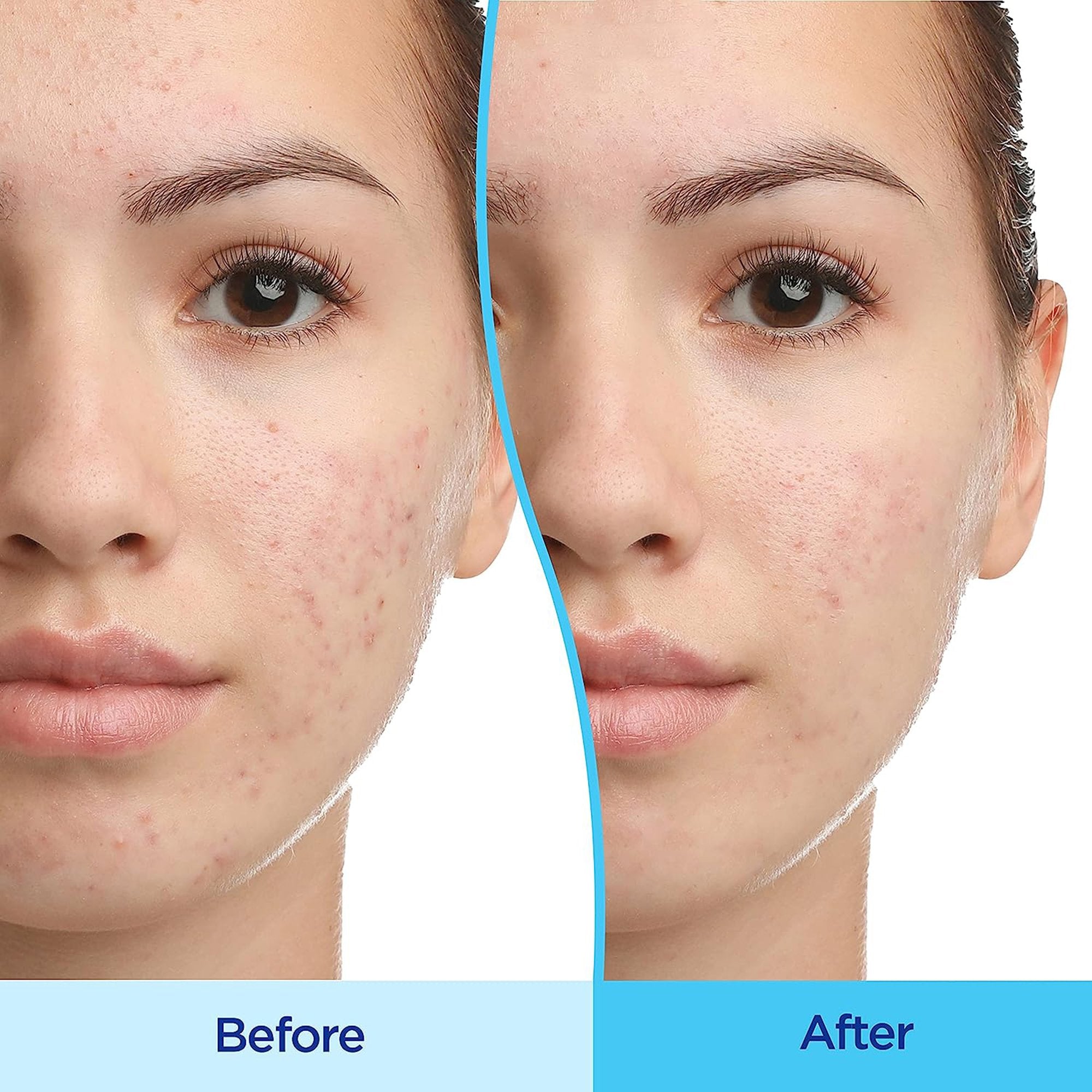 Acne Treatment Differin® 45 Gram Gel - image 8